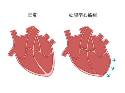 拡張型⼼筋症について