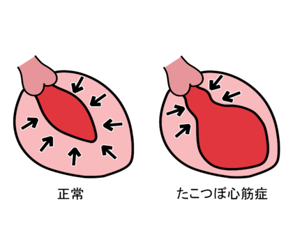 たこつぼ型心筋症