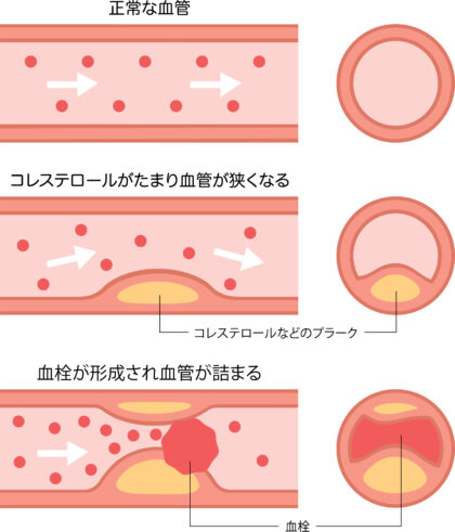 動脈硬化