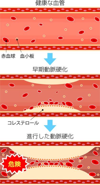 動脈硬化